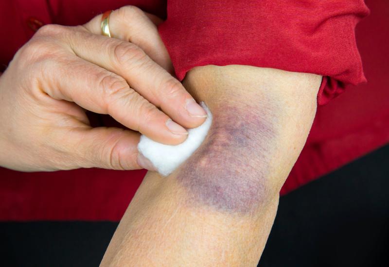 Compress on bruise