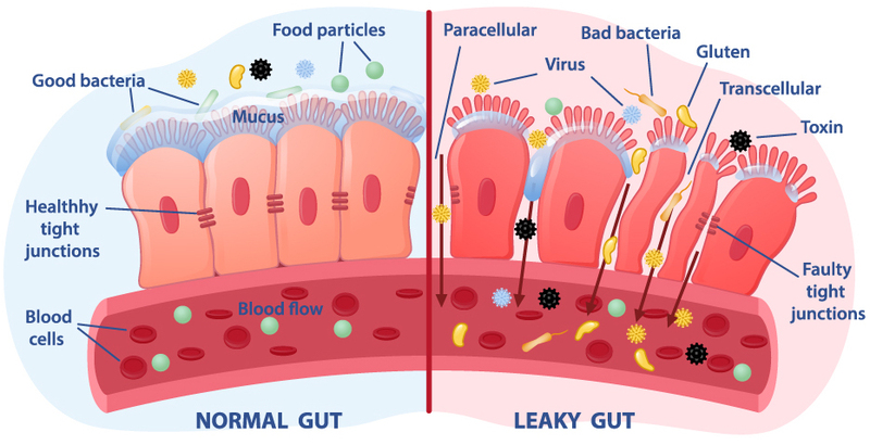 Normal Gut vs Leaky Gut