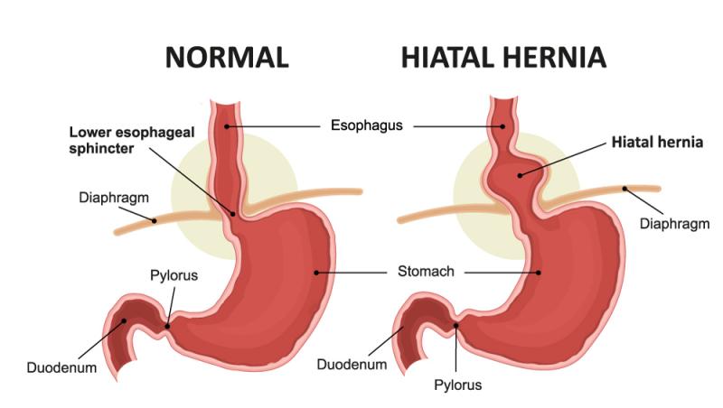 Correcting a Hiatal Hernia